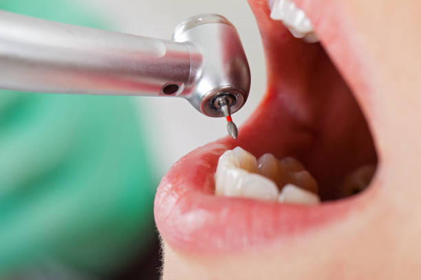 Best Emergency Dentist for Lost Fillings or Crowns in Fair Plain, MI